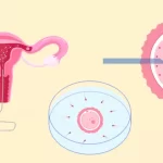 What are the Three 3 Most Common Infertility Techniques?